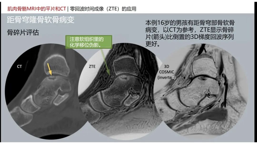 影像PPT - 【PPT】肌肉骨骼MRI中的平片和CT——零回波时间（ZTE）成像的挑战、优化和应用-33
