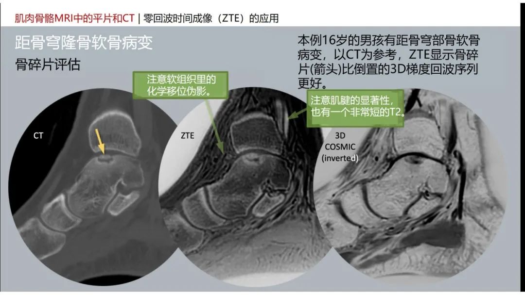 影像PPT - 【PPT】肌肉骨骼MRI中的平片和CT——零回波时间（ZTE）成像的挑战、优化和应用-35