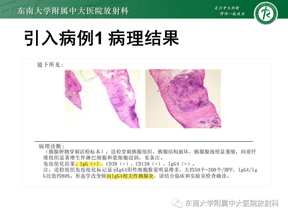 影像PPT - 【PPT】局灶型IgG4相关性自身免疫性胰腺炎-5