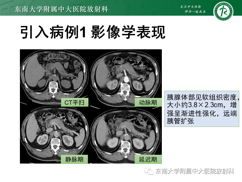 影像PPT - 【PPT】局灶型IgG4相关性自身免疫性胰腺炎-3