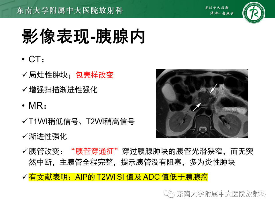 影像PPT - 【PPT】局灶型IgG4相关性自身免疫性胰腺炎-11