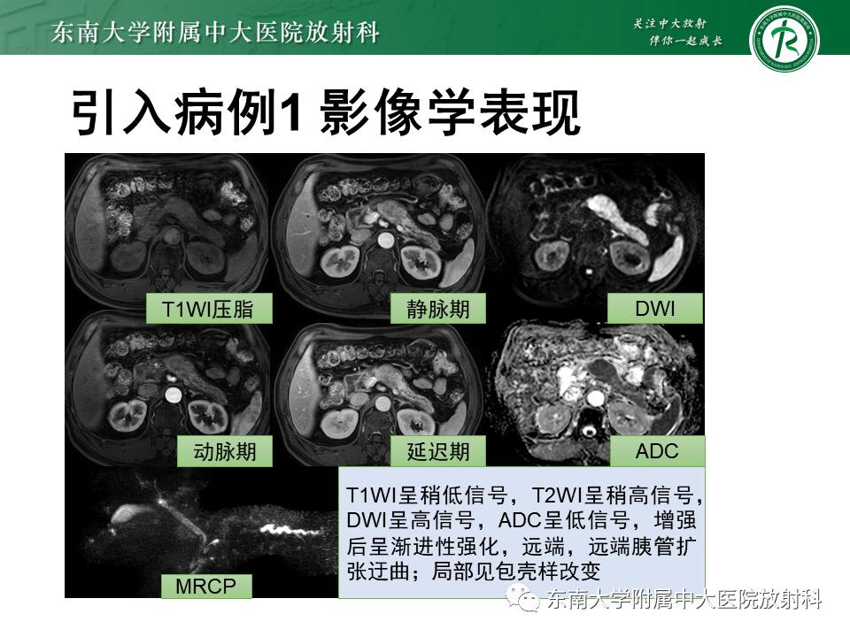 影像PPT - 【PPT】局灶型IgG4相关性自身免疫性胰腺炎-4