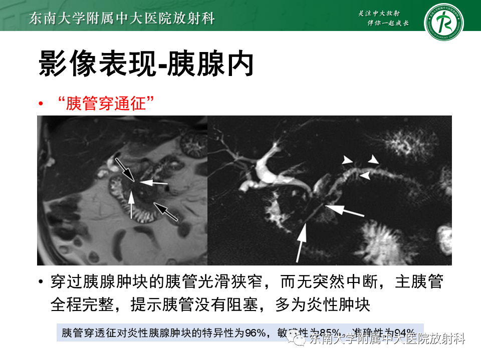 影像PPT - 【PPT】局灶型IgG4相关性自身免疫性胰腺炎-12