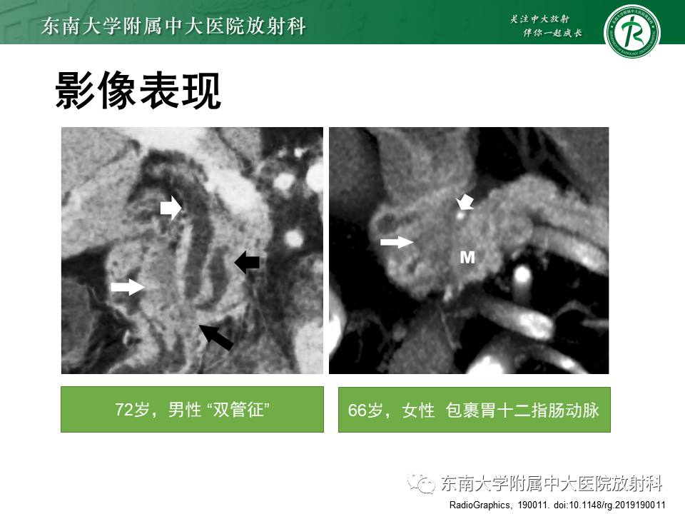 影像PPT - 【PPT】局灶型IgG4相关性自身免疫性胰腺炎-17