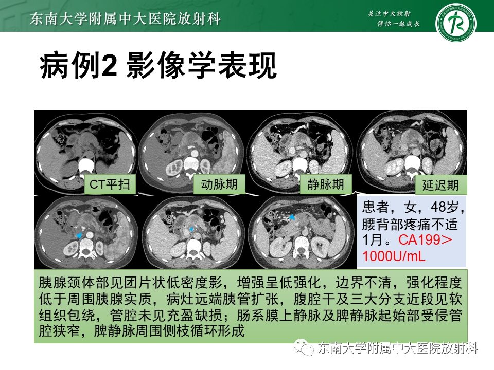 影像PPT - 【PPT】局灶型IgG4相关性自身免疫性胰腺炎-18