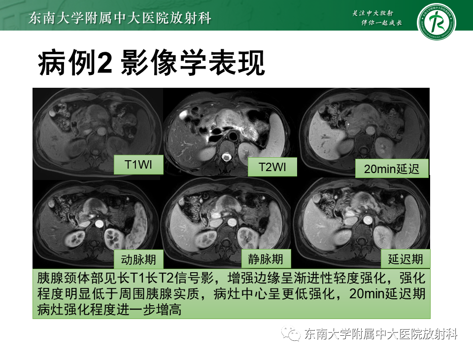 影像PPT - 【PPT】局灶型IgG4相关性自身免疫性胰腺炎-19