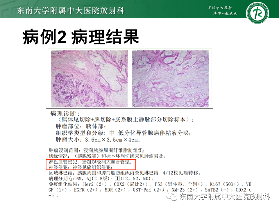 影像PPT - 【PPT】局灶型IgG4相关性自身免疫性胰腺炎-20