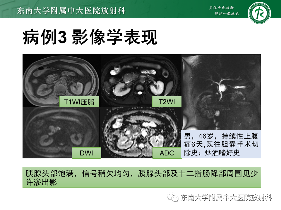 影像PPT - 【PPT】局灶型IgG4相关性自身免疫性胰腺炎-29
