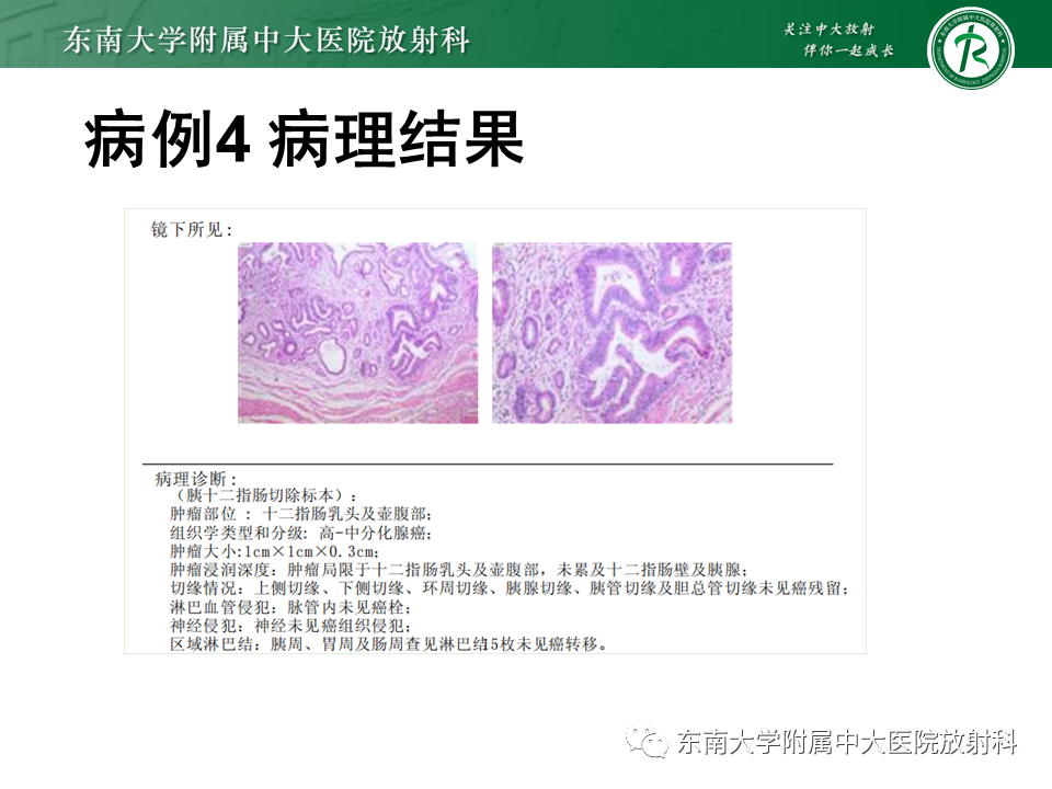 影像PPT - 【PPT】局灶型IgG4相关性自身免疫性胰腺炎-35