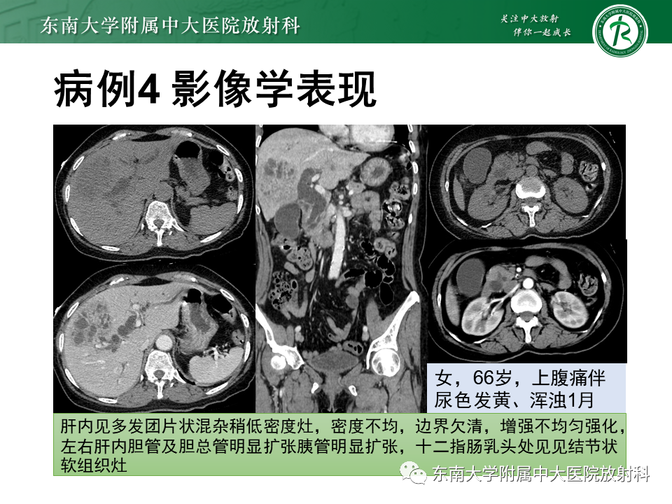 影像PPT - 【PPT】局灶型IgG4相关性自身免疫性胰腺炎-34