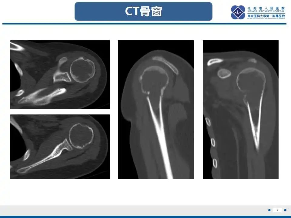 影像PPT - 【PPT】骨巨细胞瘤-4