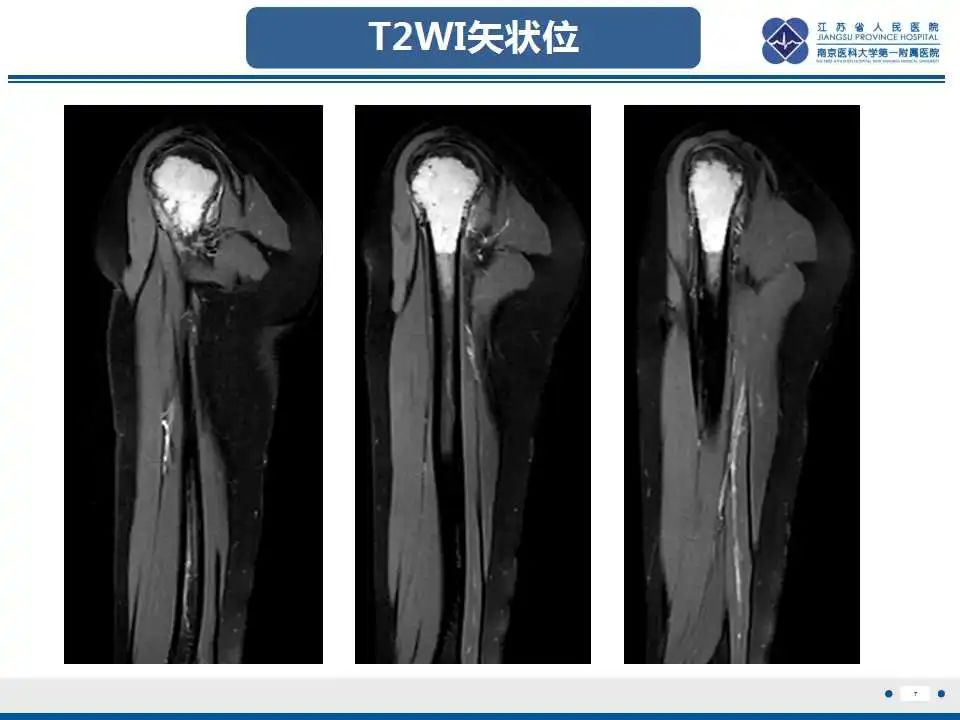 影像PPT - 【PPT】骨巨细胞瘤-8