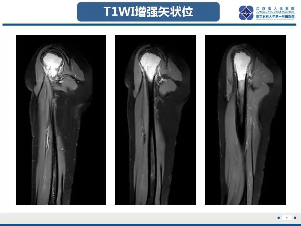 影像PPT - 【PPT】骨巨细胞瘤-12