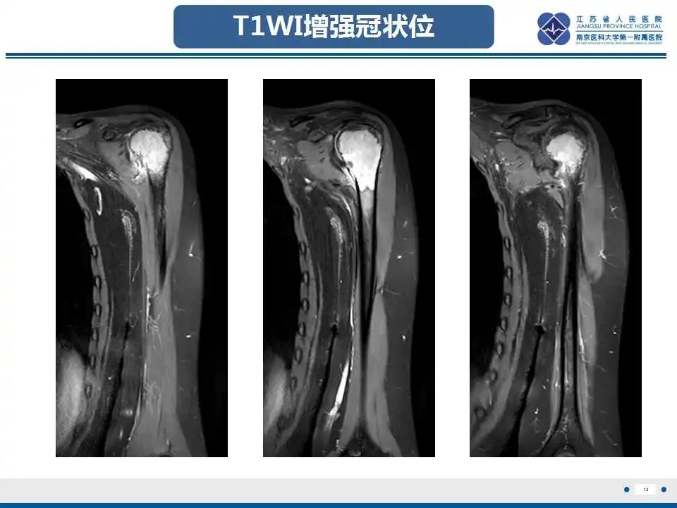 影像PPT - 【PPT】骨巨细胞瘤-13