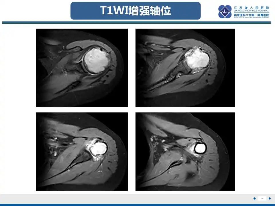 影像PPT - 【PPT】骨巨细胞瘤-11