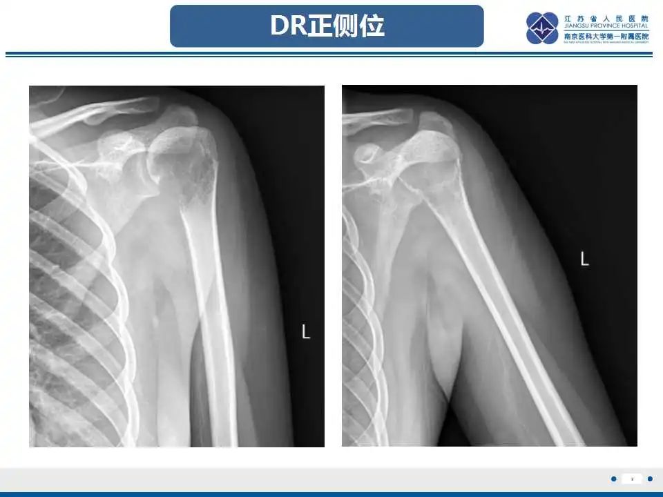 影像PPT - 【PPT】骨巨细胞瘤-3