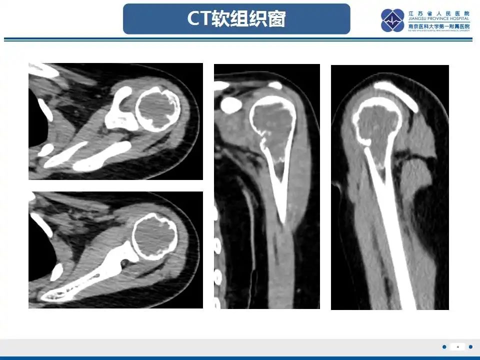 影像PPT - 【PPT】骨巨细胞瘤-5