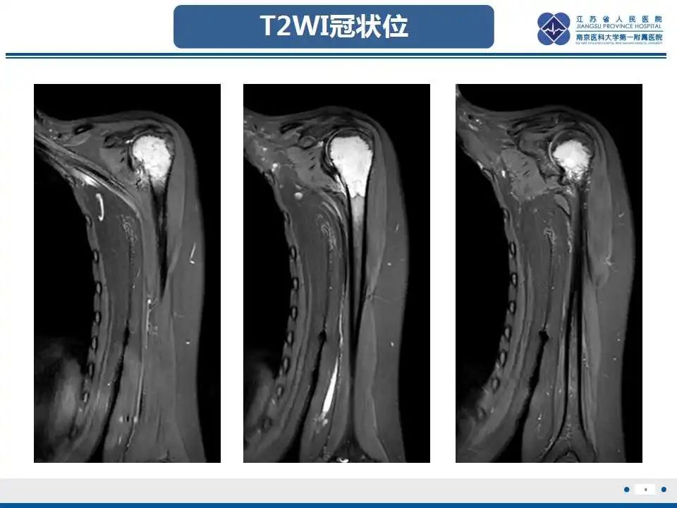影像PPT - 【PPT】骨巨细胞瘤-7