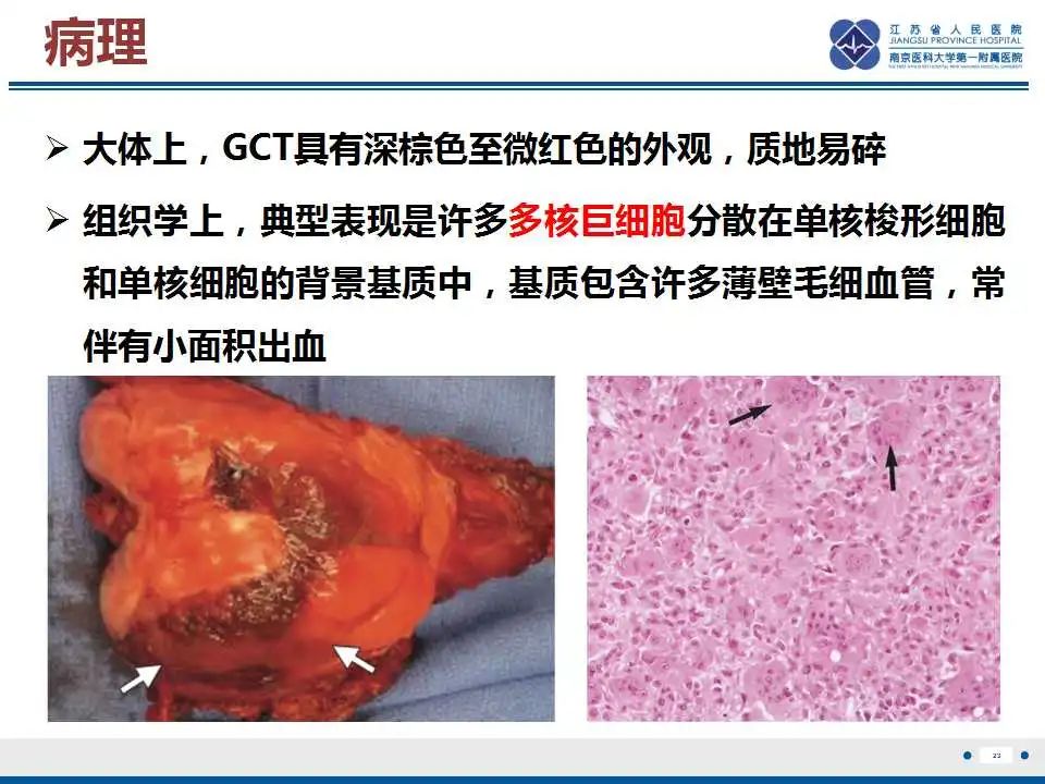 影像PPT - 【PPT】骨巨细胞瘤-24