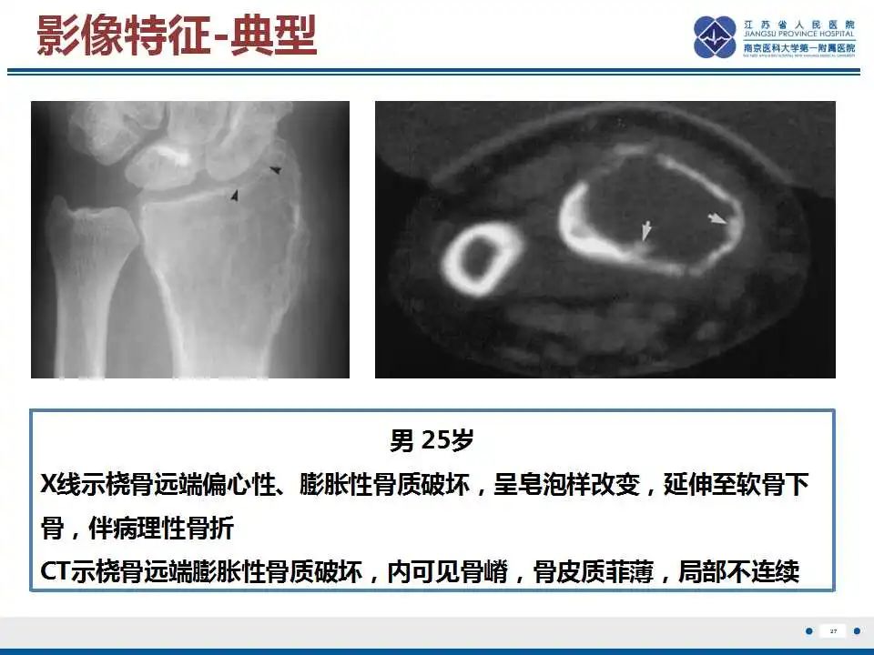 影像PPT - 【PPT】骨巨细胞瘤-28
