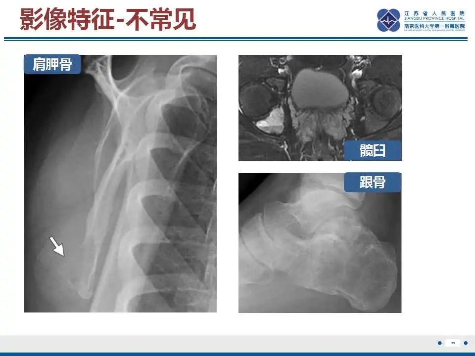 影像PPT - 【PPT】骨巨细胞瘤-30