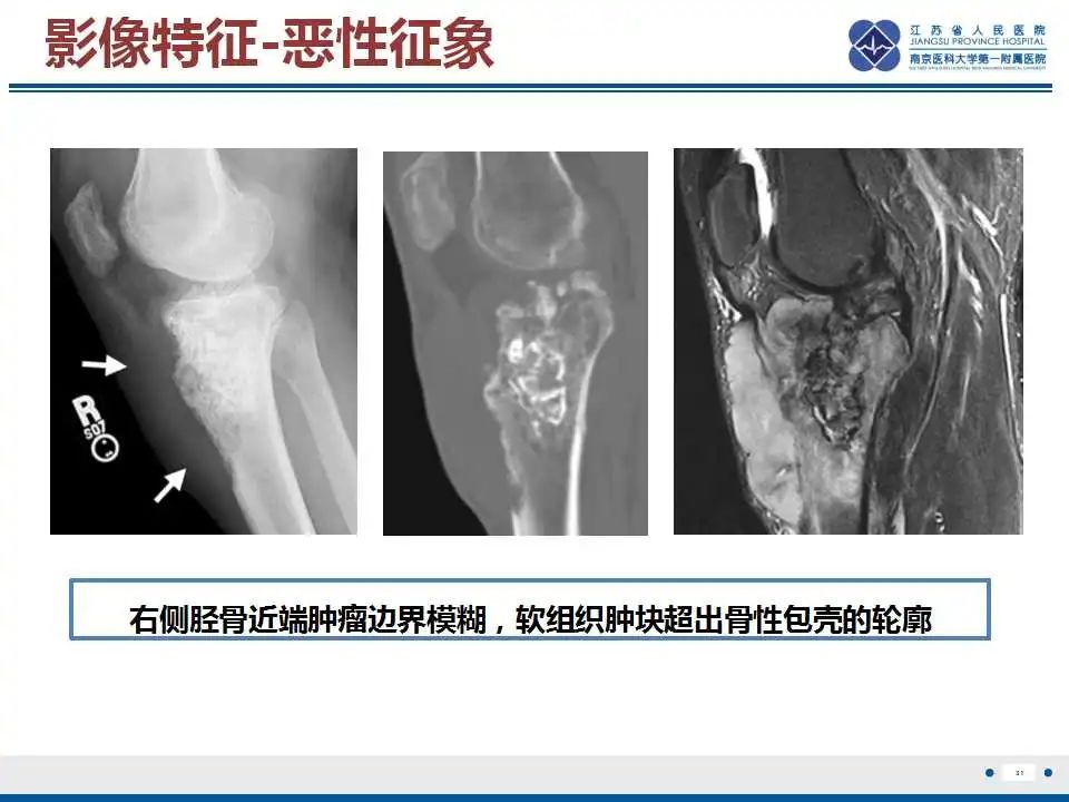 影像PPT - 【PPT】骨巨细胞瘤-32