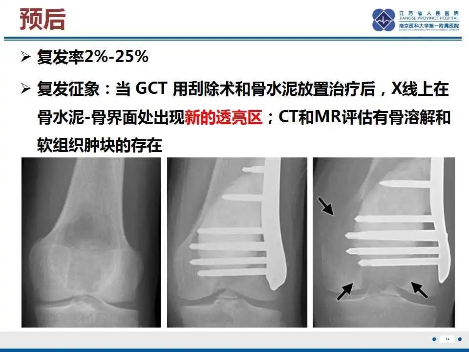 影像PPT - 【PPT】骨巨细胞瘤-35