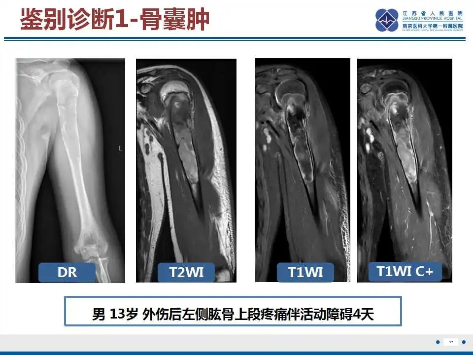 影像PPT - 【PPT】骨巨细胞瘤-38