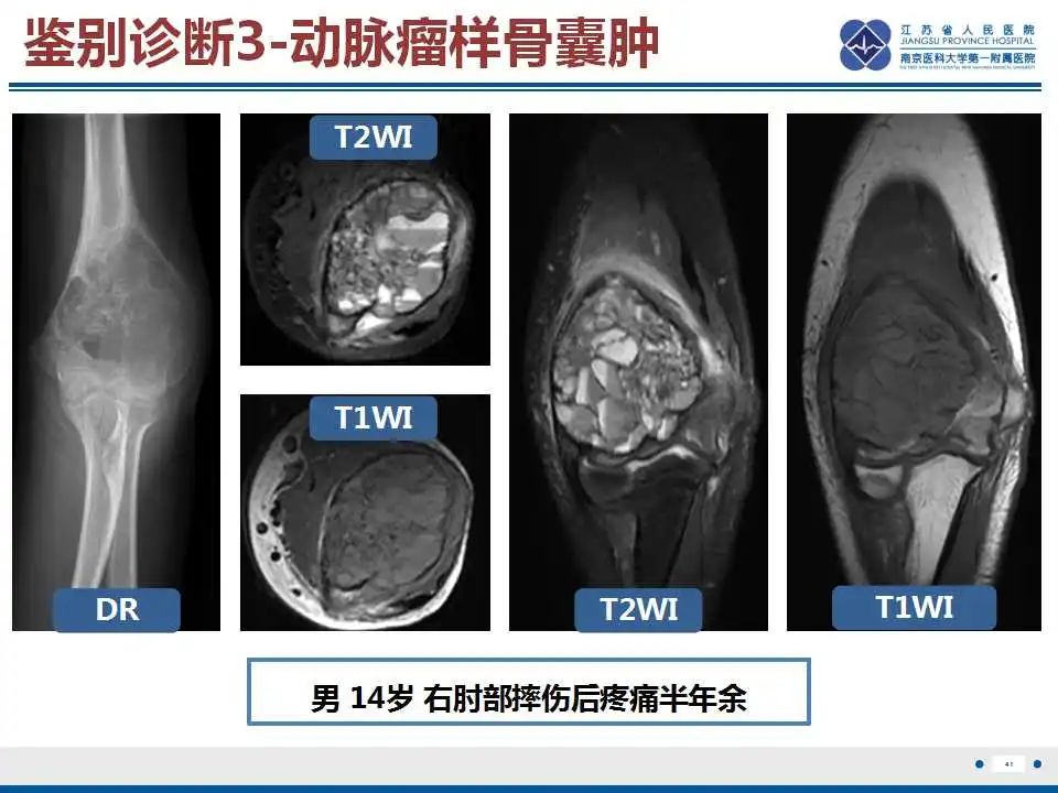 影像PPT - 【PPT】骨巨细胞瘤-42