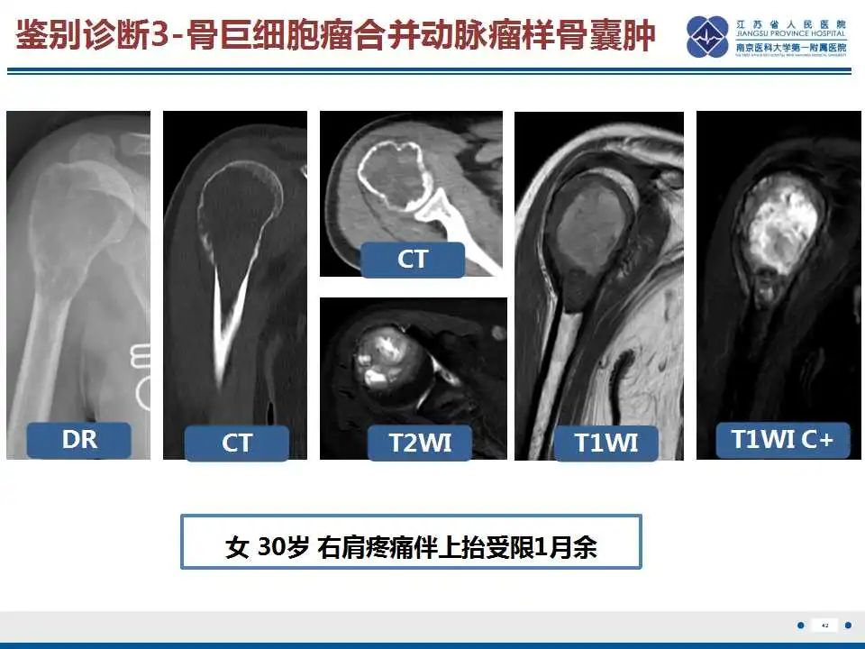 影像PPT - 【PPT】骨巨细胞瘤-43