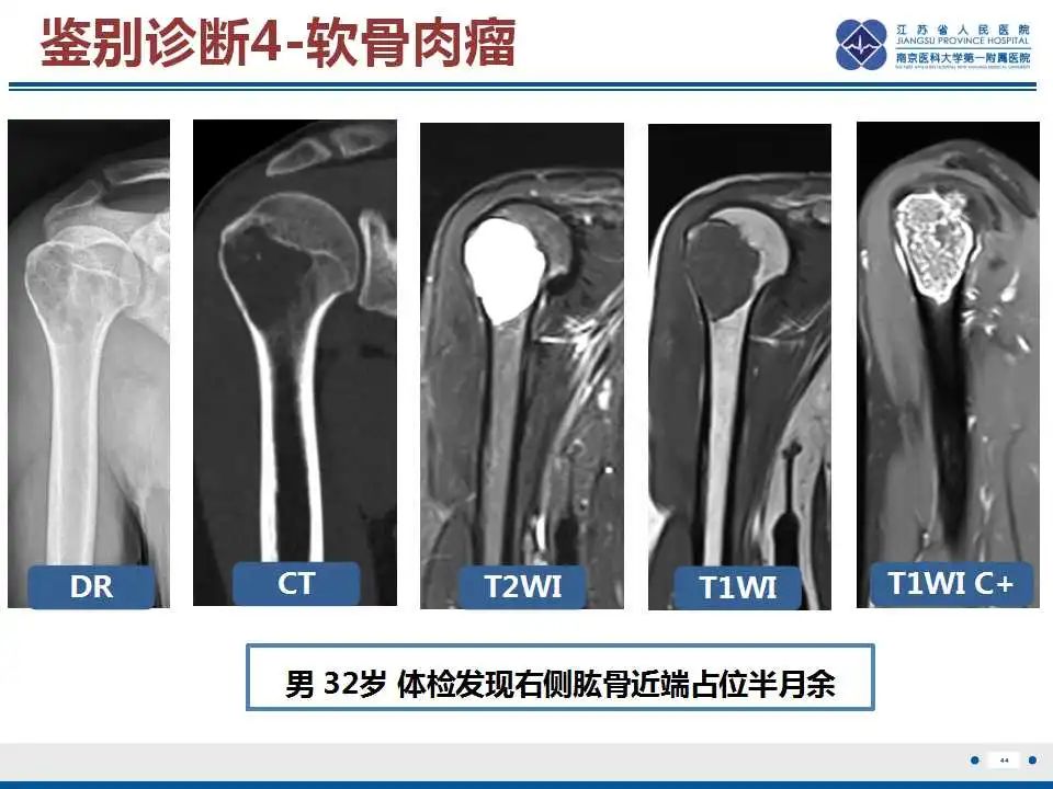 影像PPT - 【PPT】骨巨细胞瘤-45