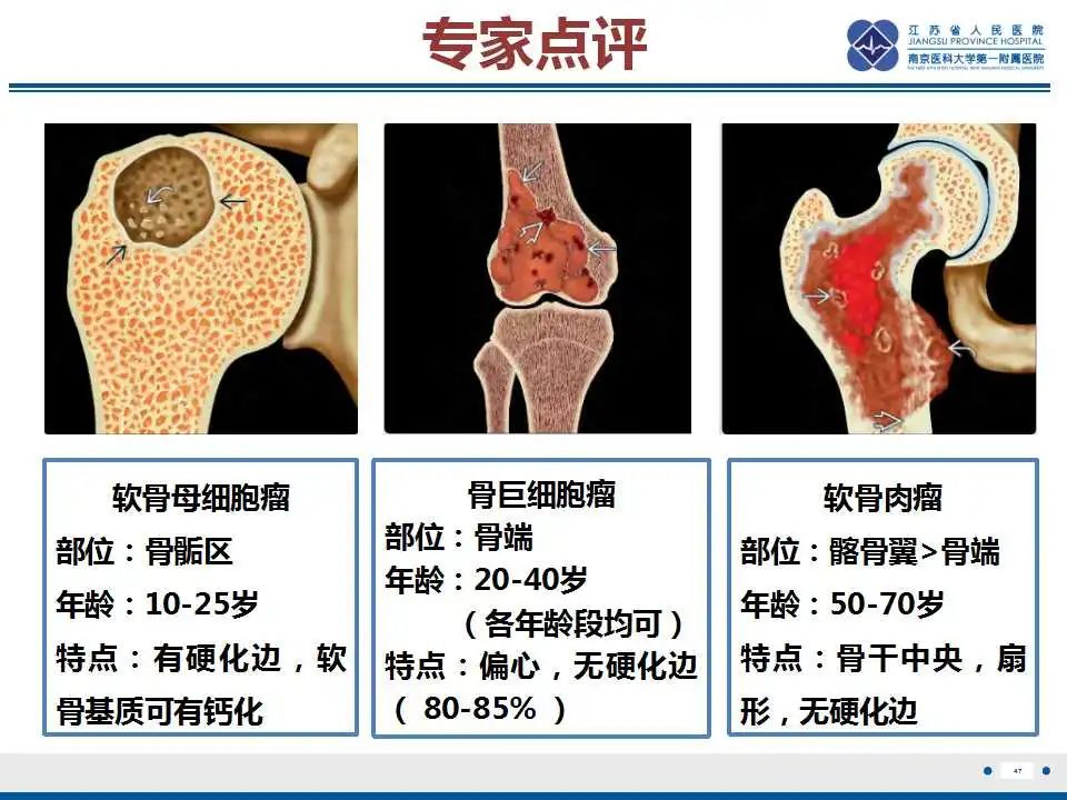影像PPT - 【PPT】骨巨细胞瘤-48