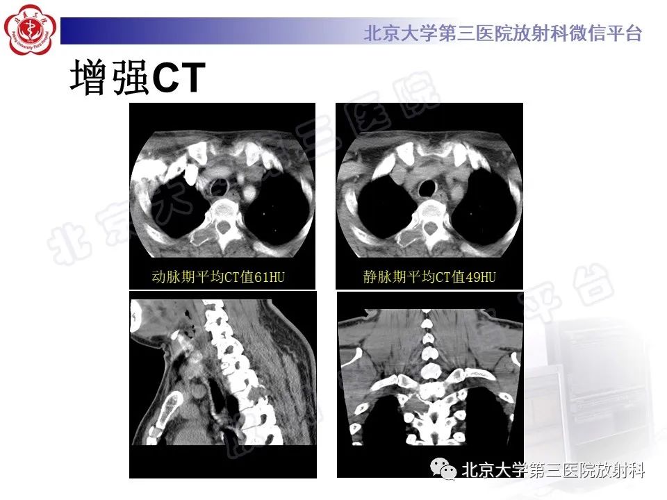 影像PPT - 【PPT】脊柱腱鞘巨细胞瘤-4