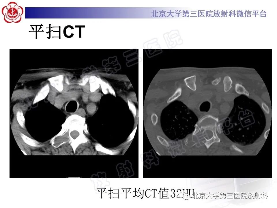 影像PPT - 【PPT】脊柱腱鞘巨细胞瘤-3