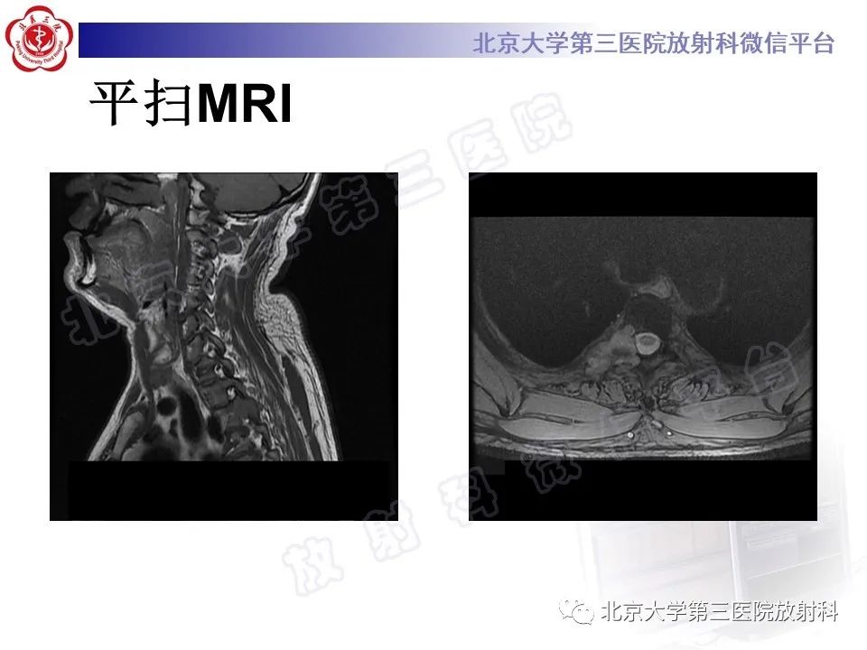 影像PPT - 【PPT】脊柱腱鞘巨细胞瘤-5