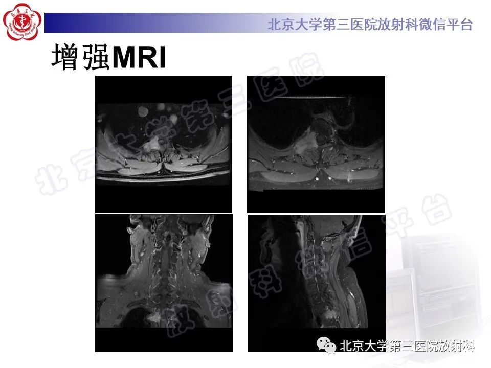 影像PPT - 【PPT】脊柱腱鞘巨细胞瘤-6