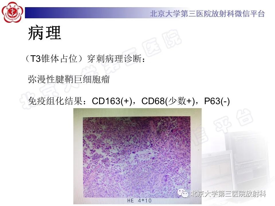 影像PPT - 【PPT】脊柱腱鞘巨细胞瘤-9
