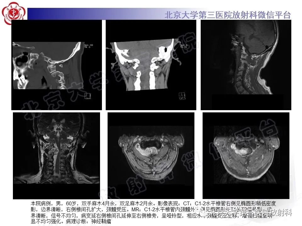 影像PPT - 【PPT】脊柱腱鞘巨细胞瘤-20