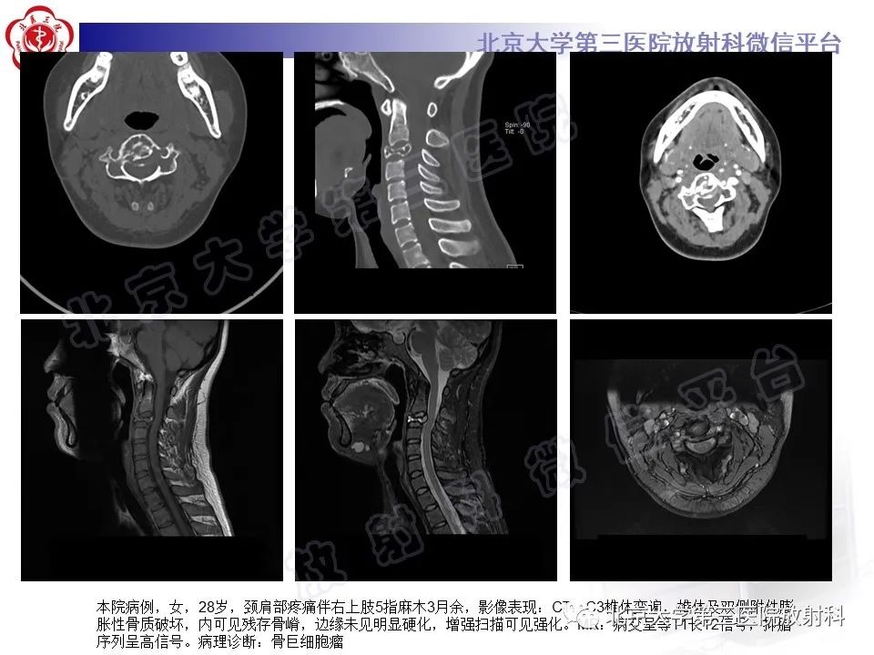 影像PPT - 【PPT】脊柱腱鞘巨细胞瘤-18