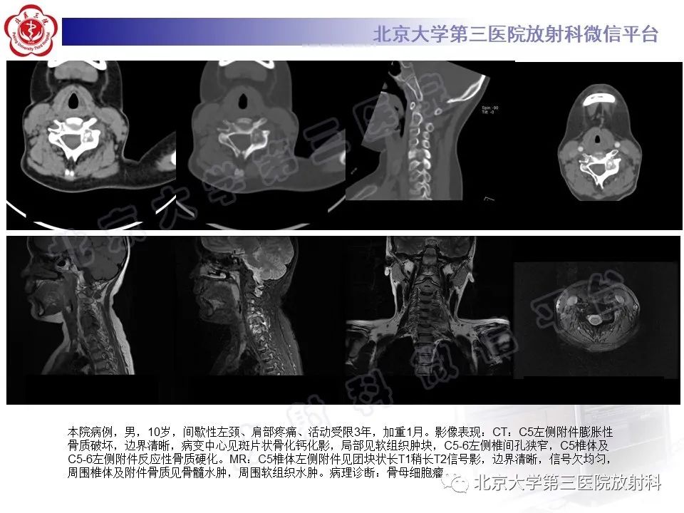 影像PPT - 【PPT】脊柱腱鞘巨细胞瘤-22
