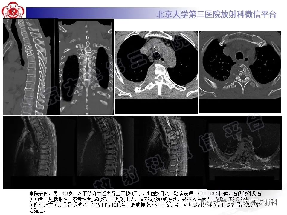 影像PPT - 【PPT】脊柱腱鞘巨细胞瘤-24