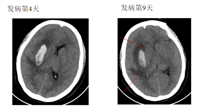 影像PPT - 脑出血周围水肿的发生机制-3