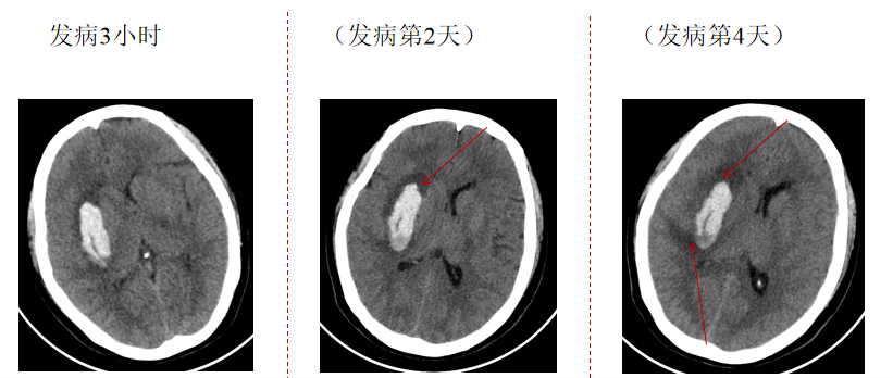 影像PPT - 脑出血周围水肿的发生机制-2