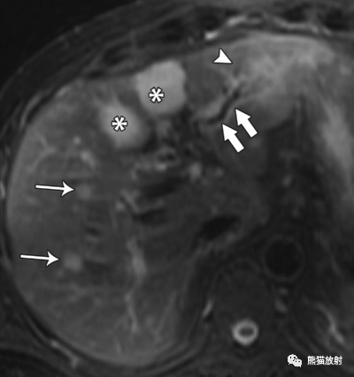 影像PPT - 胆道感染临床及影像表现-3 影像PPT - 胆道感染临床及影像表现-3
