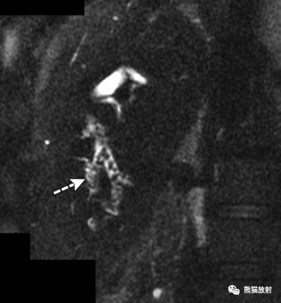 影像PPT - 胆道感染临床及影像表现-12 影像PPT - 胆道感染临床及影像表现-12
