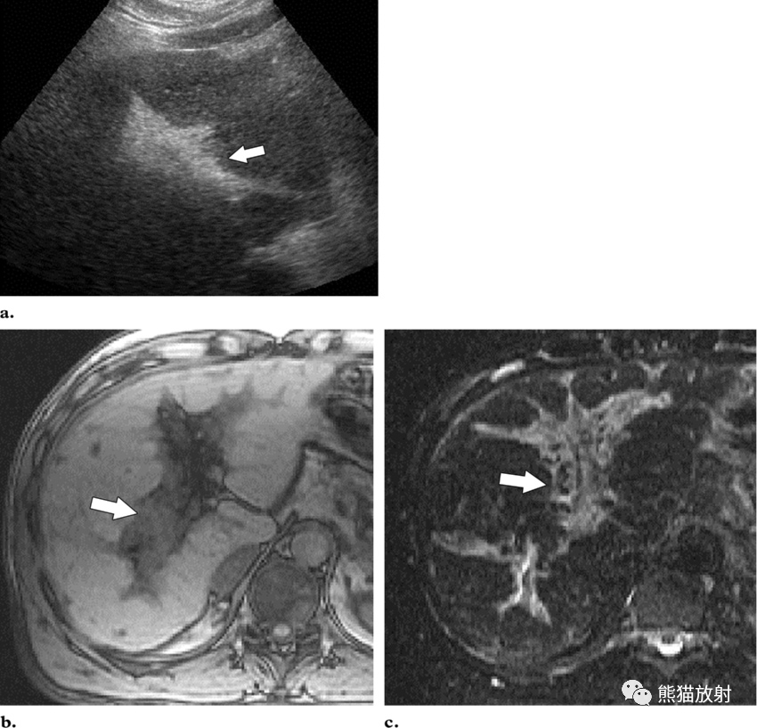 影像PPT - 胆道感染临床及影像表现-1 影像PPT - 胆道感染临床及影像表现-1