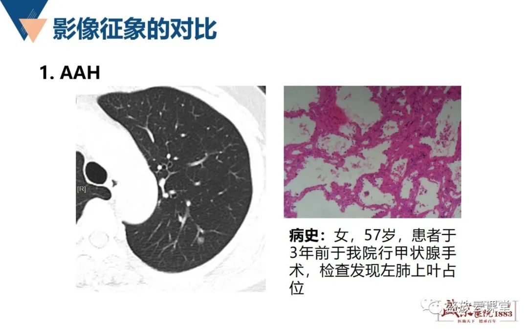 影像PPT - 【PPT】肺磨玻璃结节管理随访-9