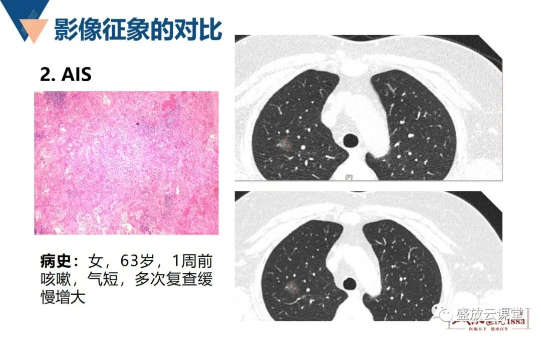 影像PPT - 【PPT】肺磨玻璃结节管理随访-11