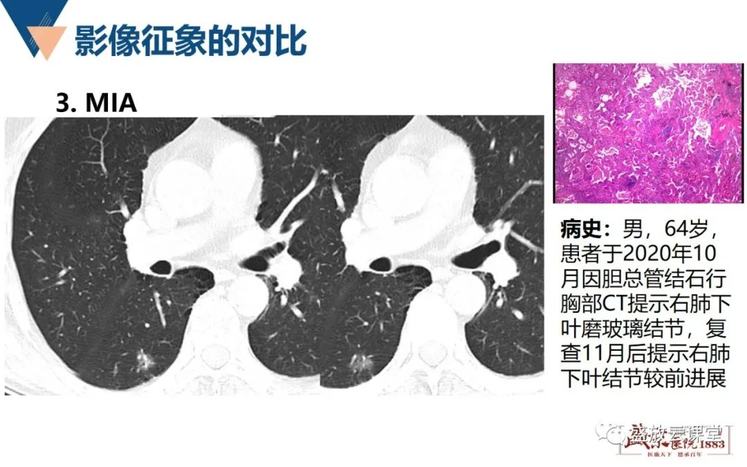 影像PPT - 【PPT】肺磨玻璃结节管理随访-13