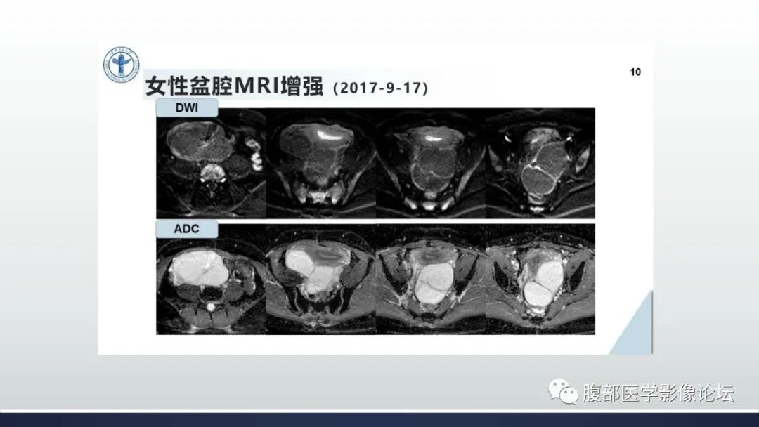 影像PPT - 【病例】卵巢过度刺激综合征1例MR影像-9